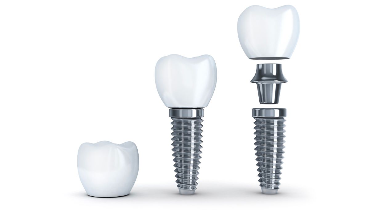 implant component